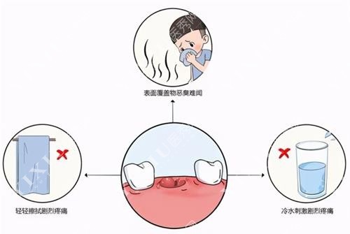 干槽症是什么图片